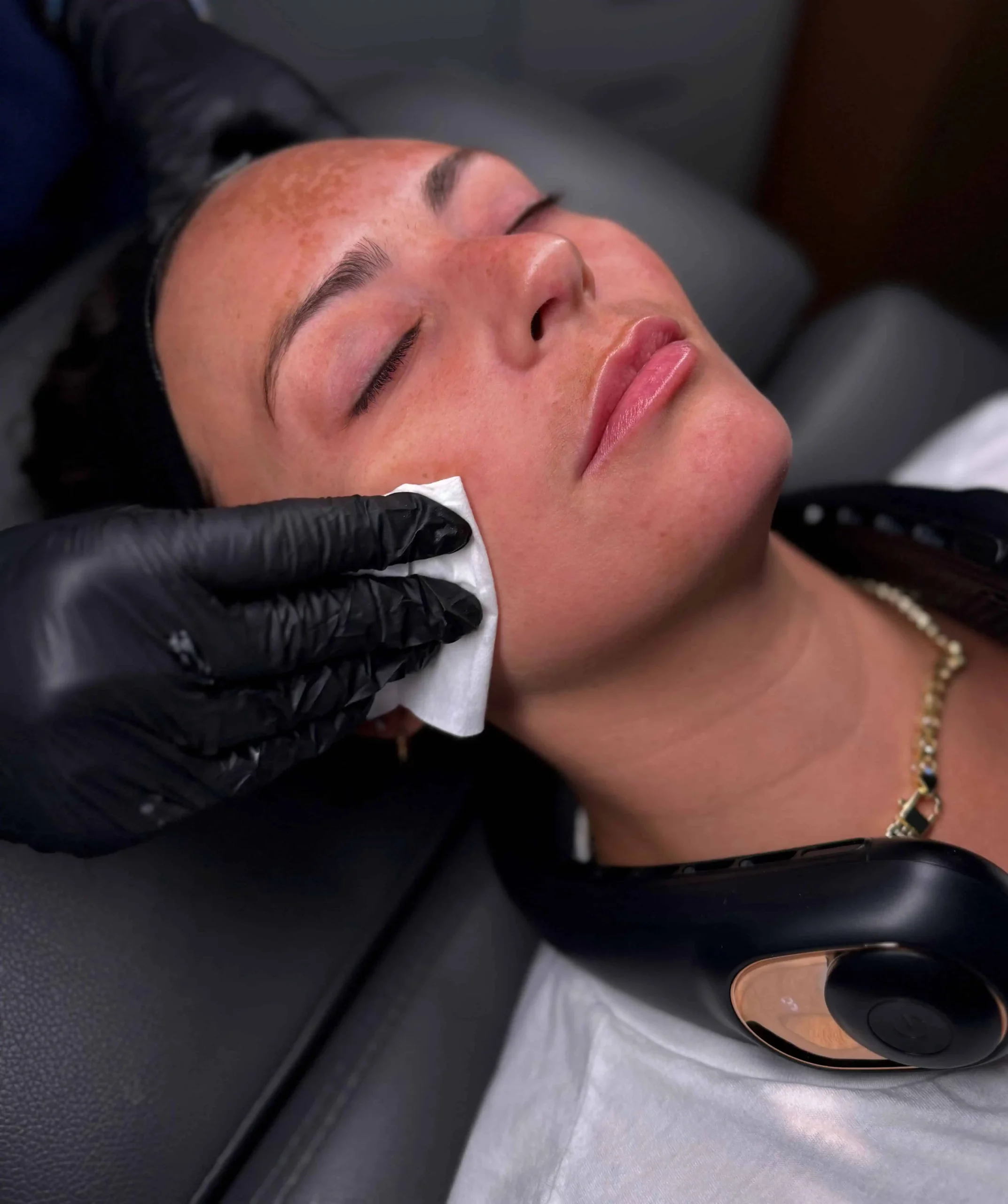 Chemical peels | Culture Aesthetics and Wellness | Knoxville, TN