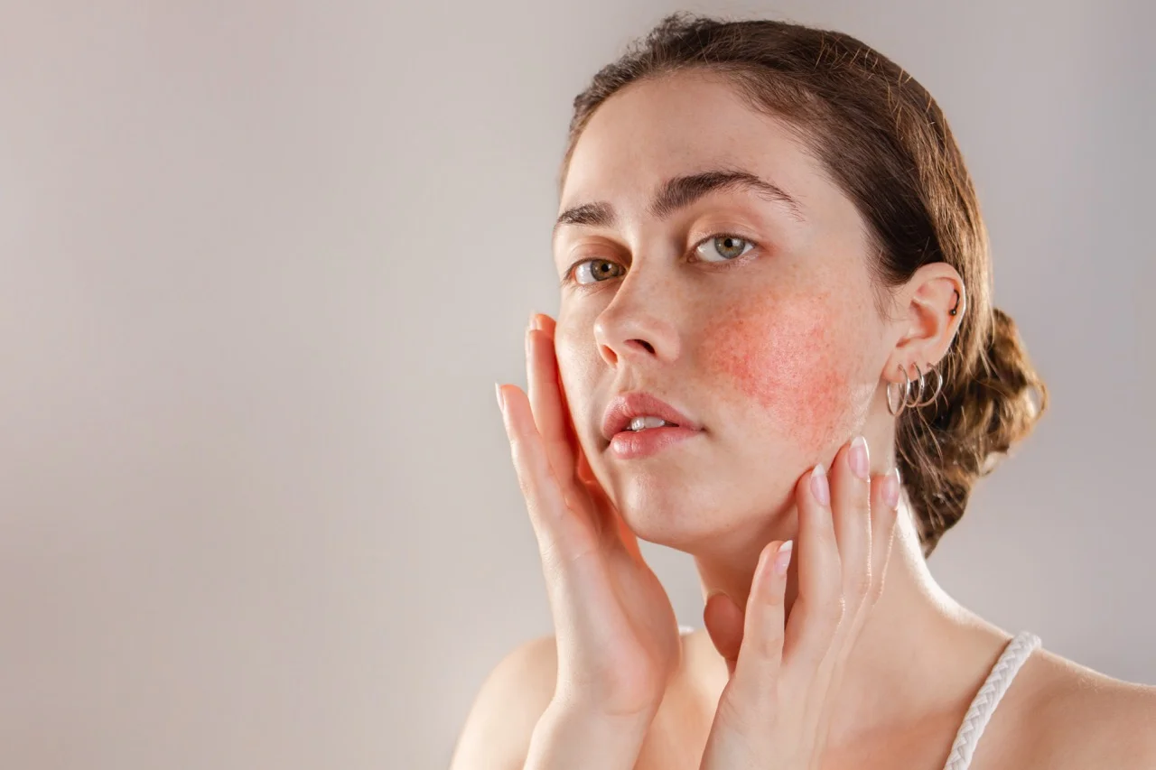 Pigmentation and Redness Treatment | Culture Aesthetics and Wellness | Knoxville, TN