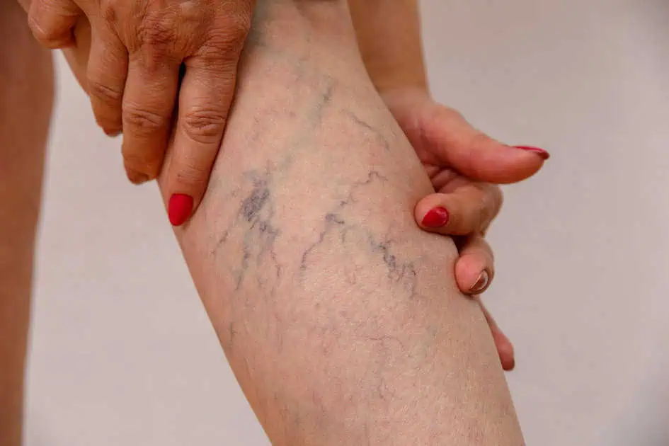 Vein and Capillary by Culture Aesthetics and Wellness, LLC in Knoxville, TN