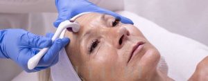 Knoxville area model woman undergoing microneedling treatment.
